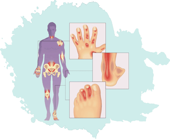 Arthritis Treatment