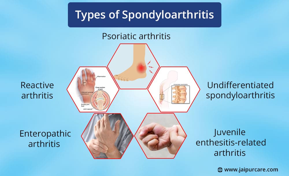 Spondyloarthritis Treatment Near Me