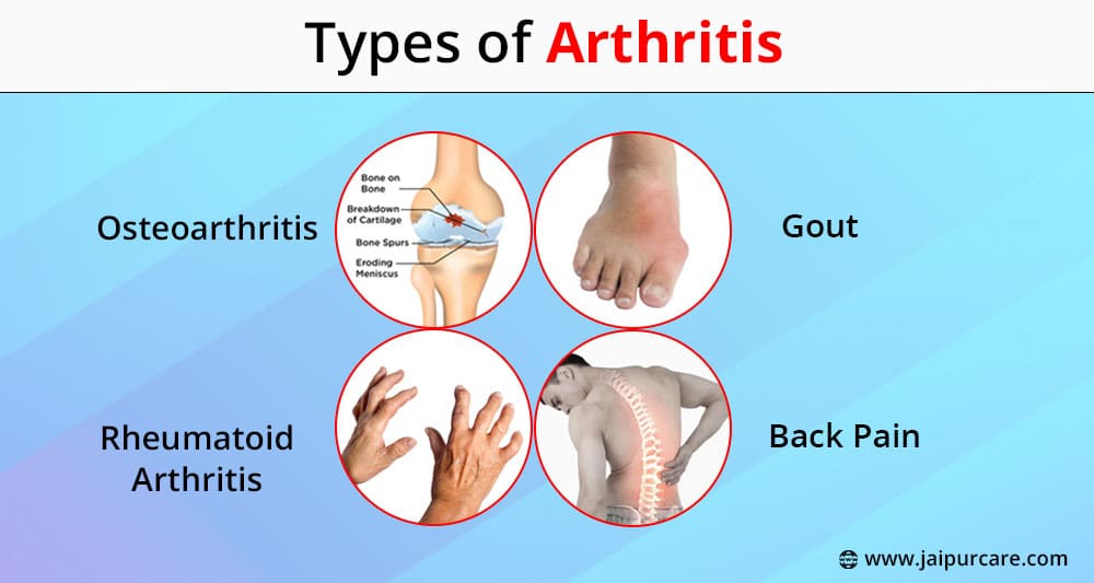 Types of Arthritis
