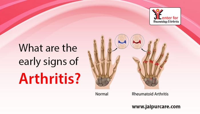 What are the early signs of arthritis?
