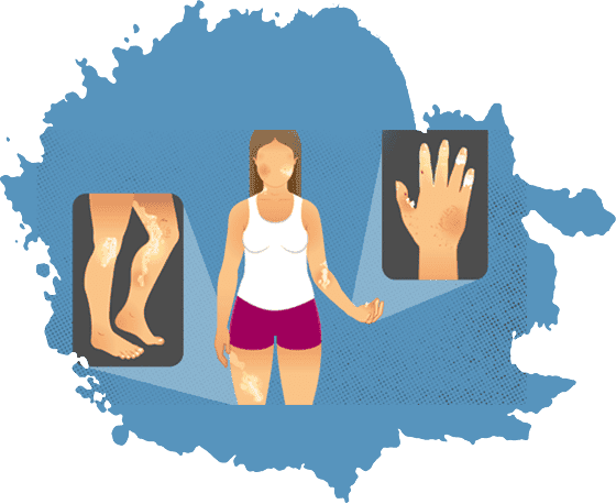Systemic Sclerosis Treatment in Jaipur