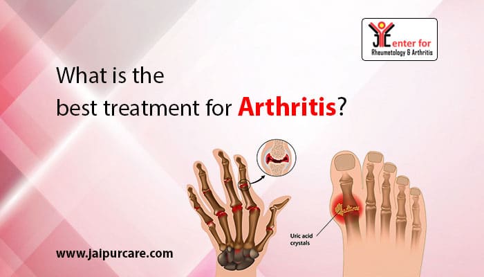 What is the best treatment for arthritis?