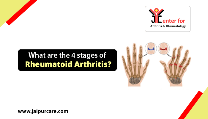 4 stages of Rheumatoid Arthritis