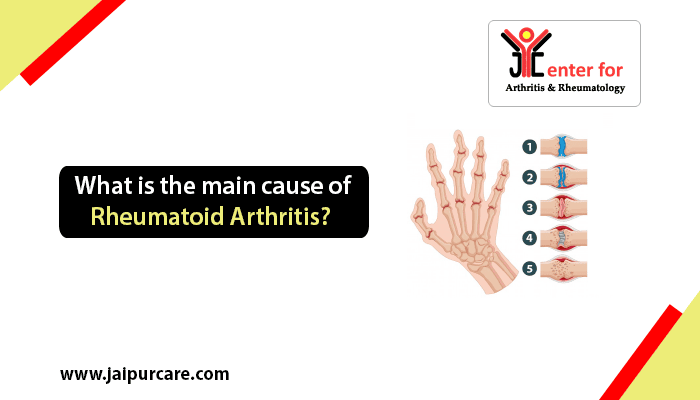 cause of rheumatoid arthritis