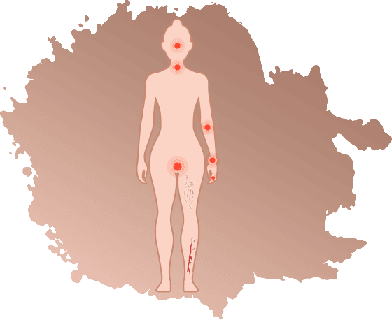 Sjogren's Syndrome Treatment in Jaipur