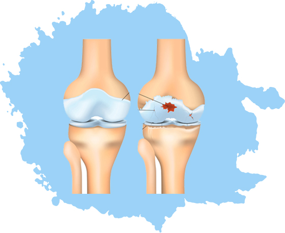 Osteoarthritis: Symptoms, Causes, Diagnosis