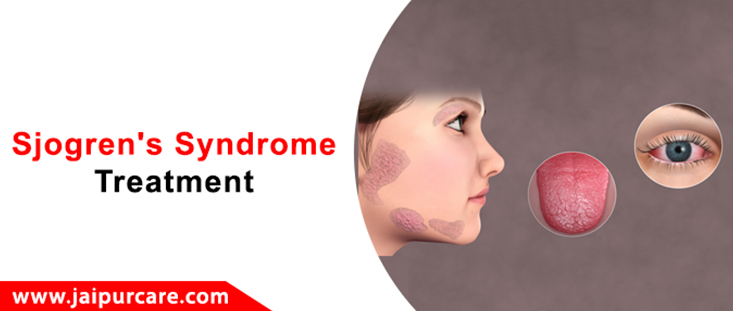 Sjogren's Syndrome Treatment in Jaipur
