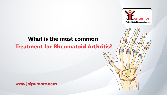 treatment for rheumatoid arthritis