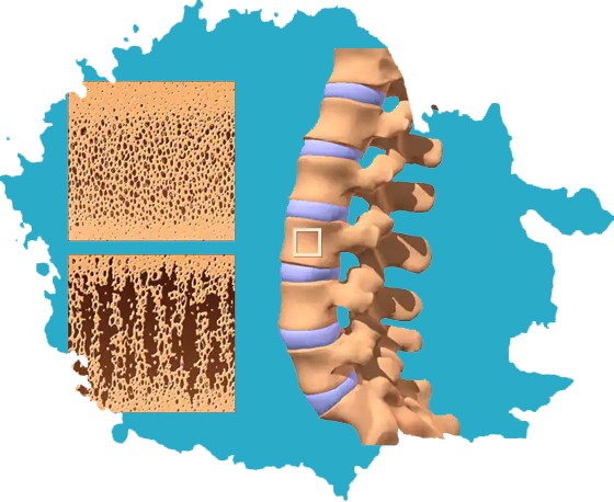 Osteoporosis and Metabolic Bone Diseases: Causes, Symptoms, Prevention