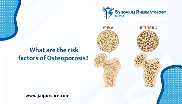 risk factors of Osteoporosis