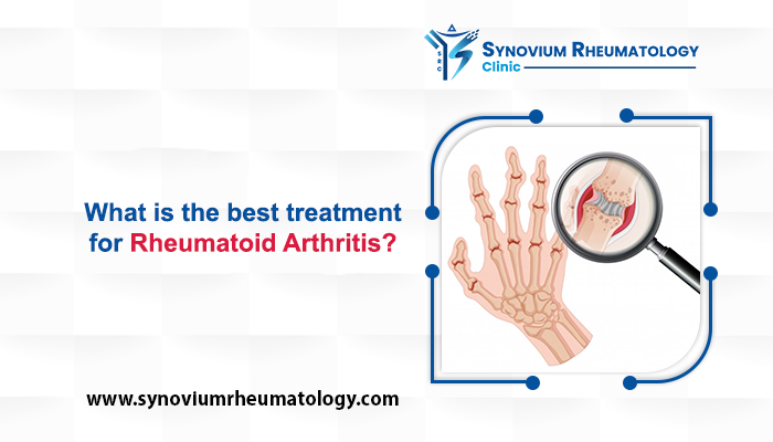 Treatment for Rheumatoid Arthritis in 2022