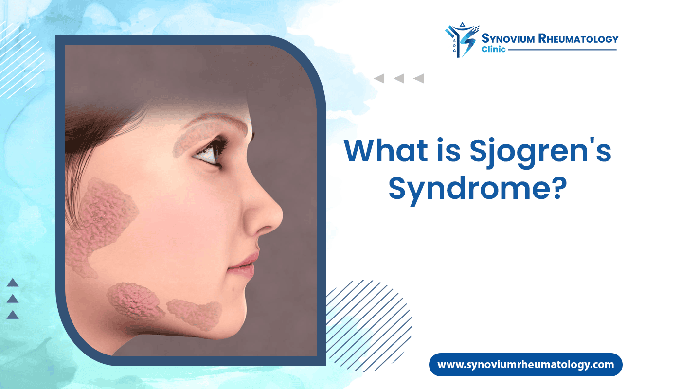 What is Sjogren’s syndrome