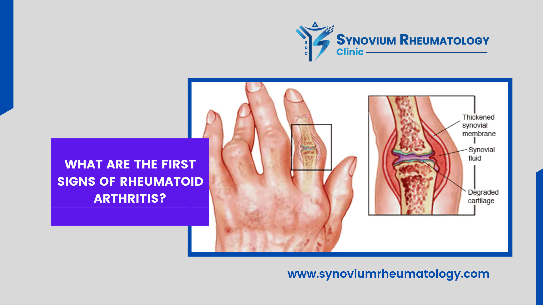 first signs of Rheumatoid Arthritis