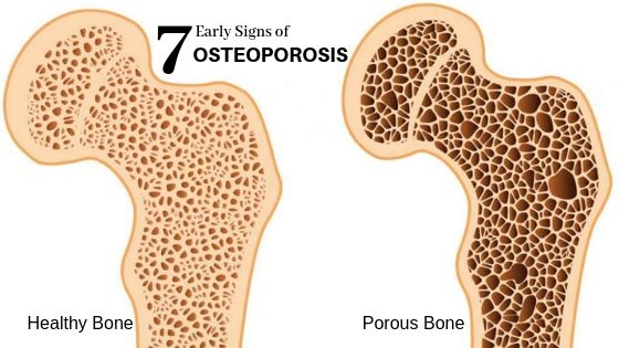 7 Symptoms of Osteopororsis