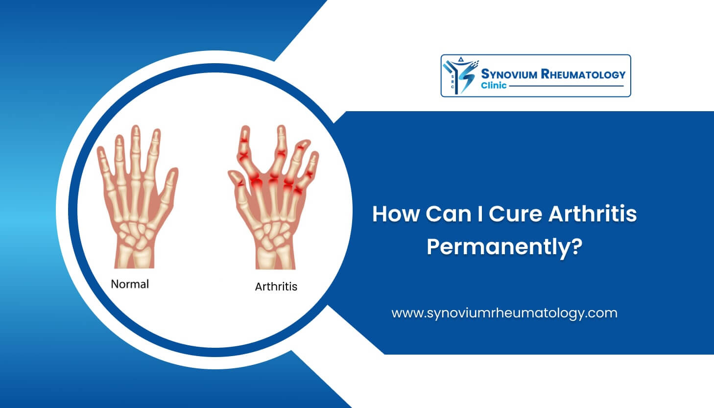 How Can I Cure Arthritis Permanently
