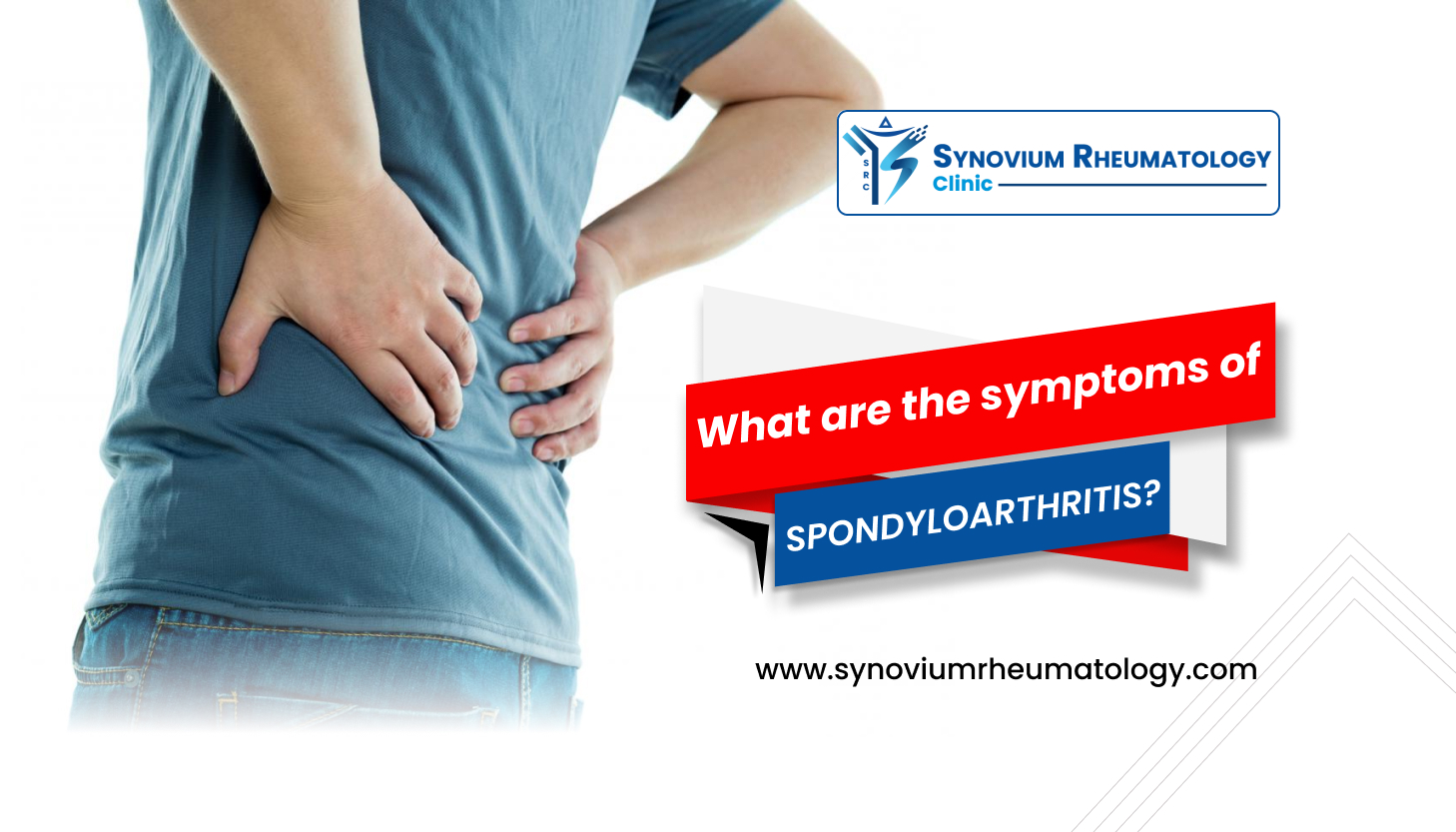 symptoms of Spondyloarthritis
