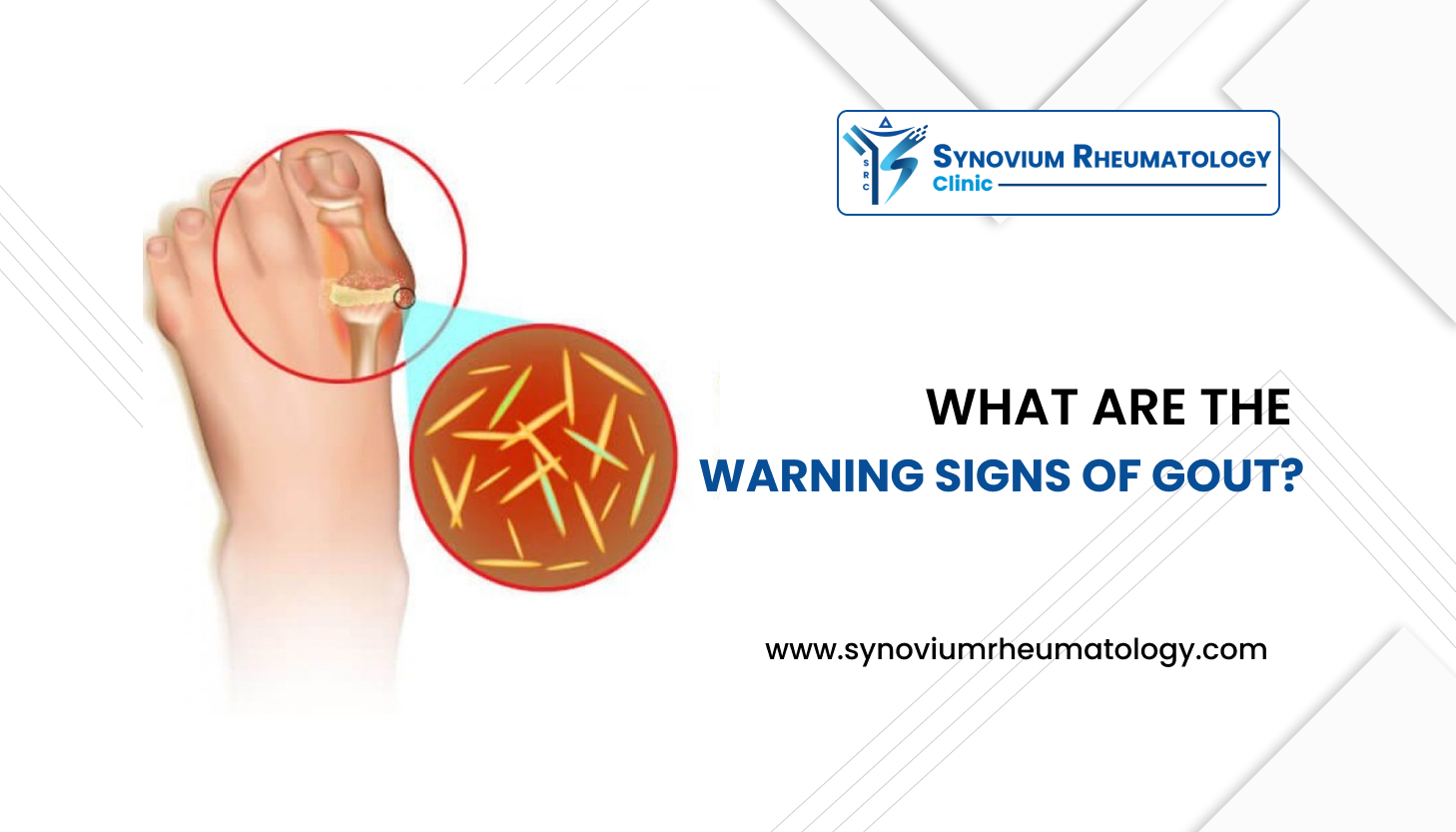 Warning Signs of Gout