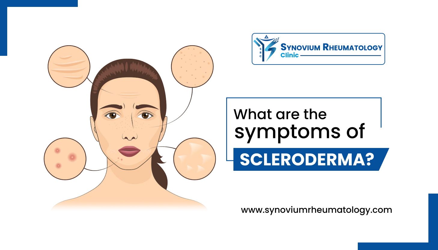 Symptoms of Scleroderma