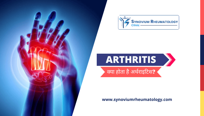 What is Arthritis in Hindi